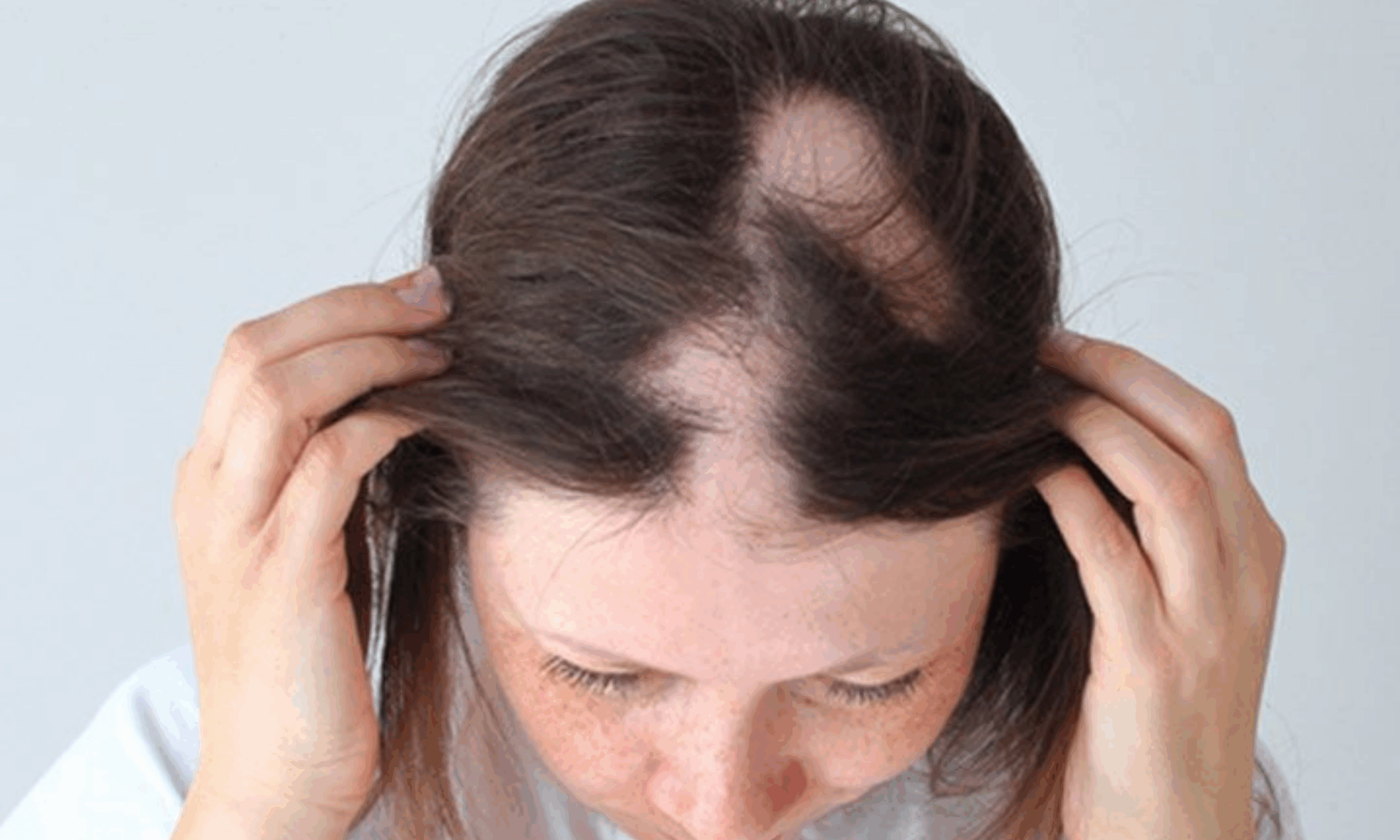alopecia