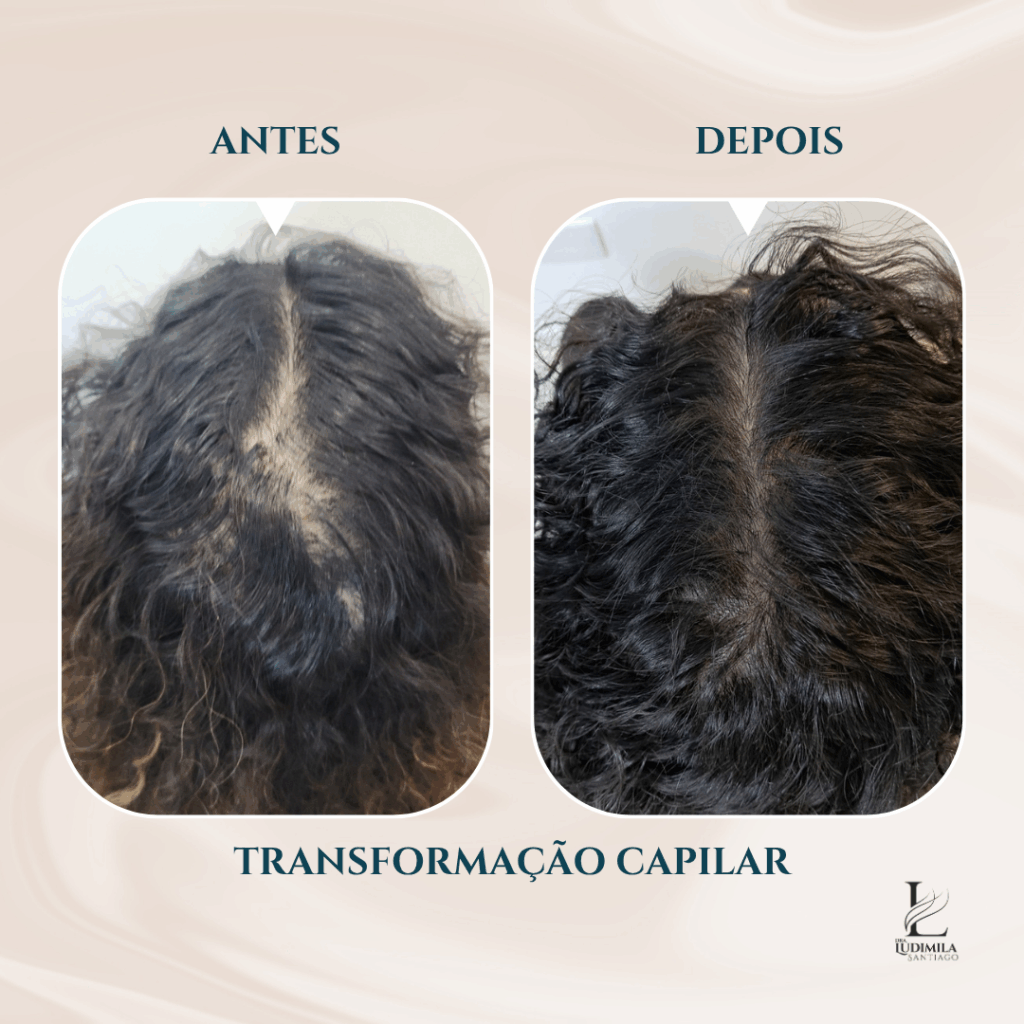Alopecia Cicatricial