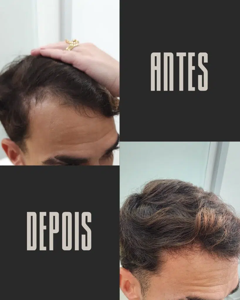 Calvície masculina