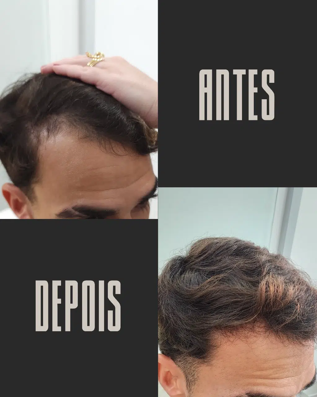 Calvície masculina