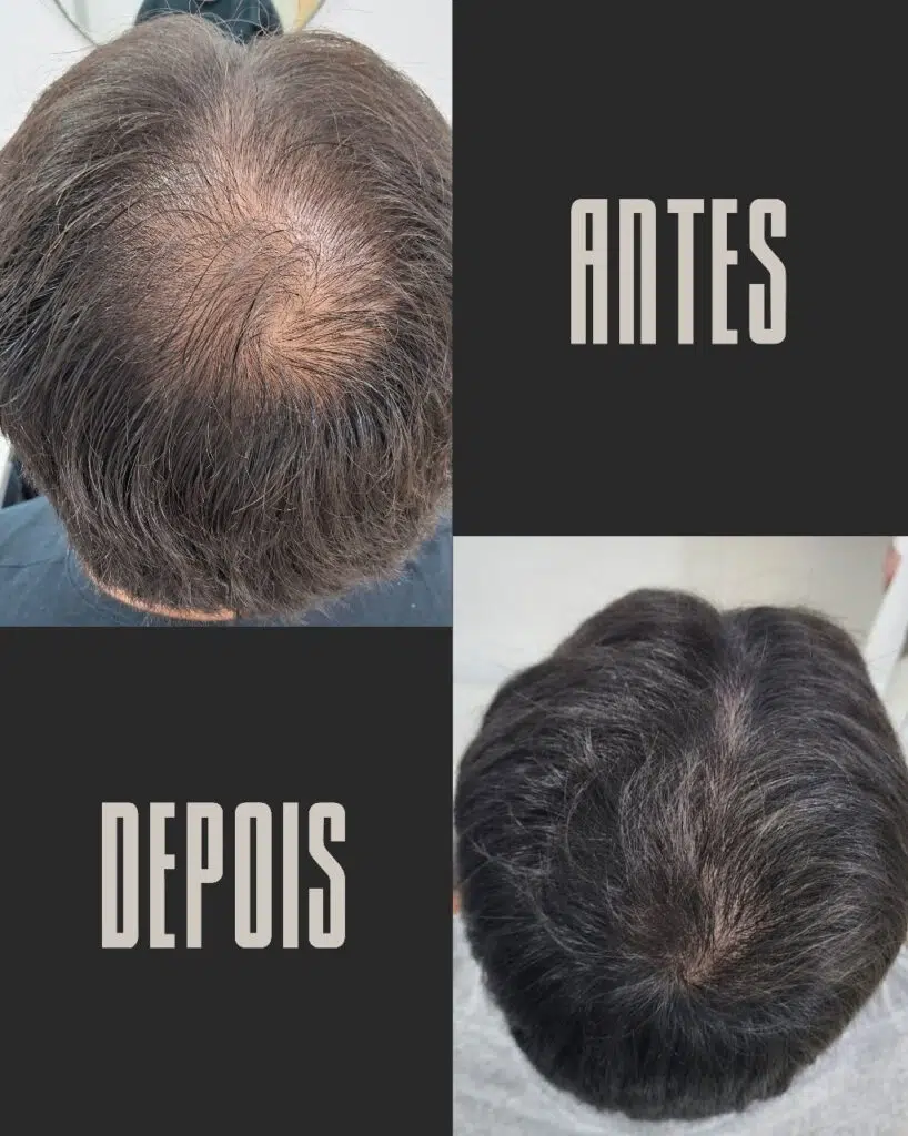Calvície masculina