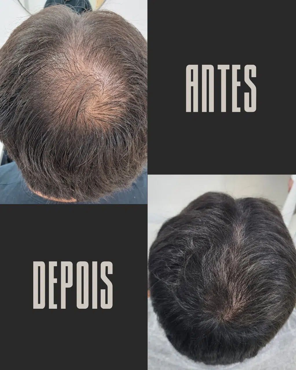 Calvície masculina