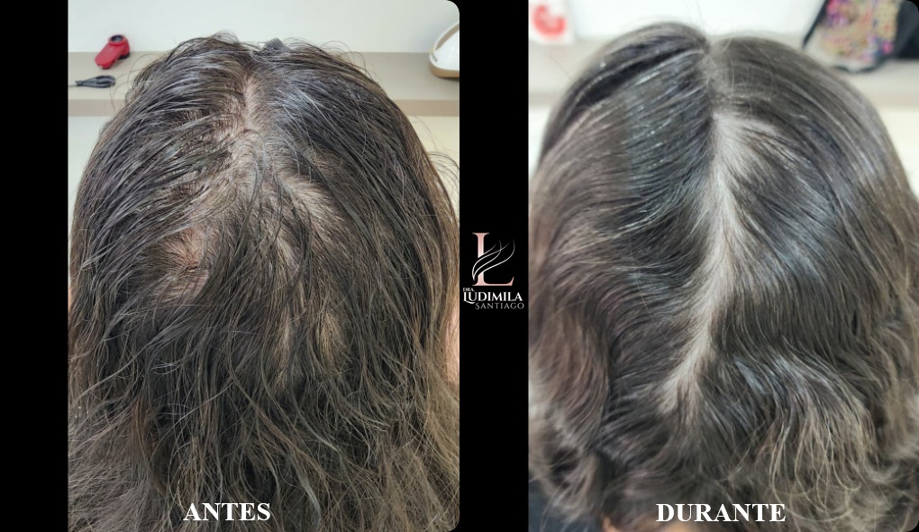 ALOPECIA CICATRICIAL