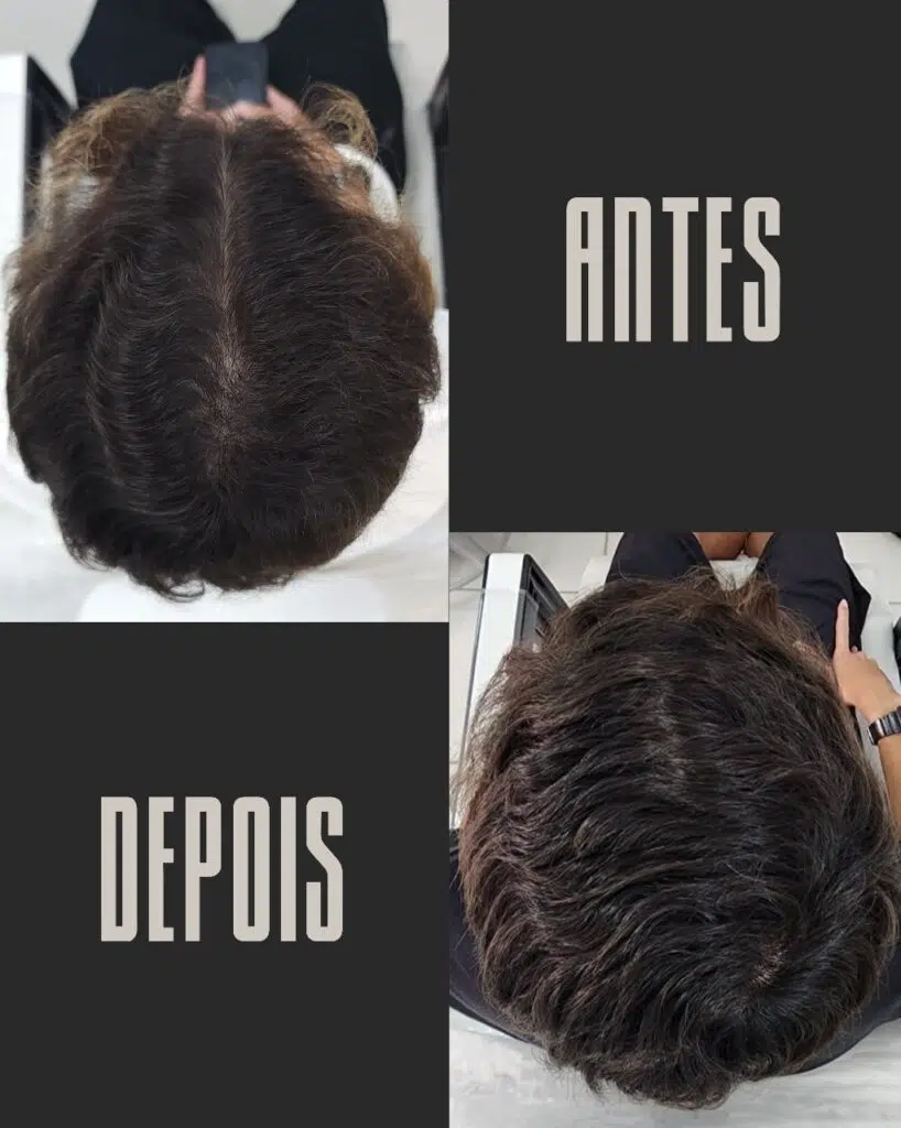 Calvície masculina