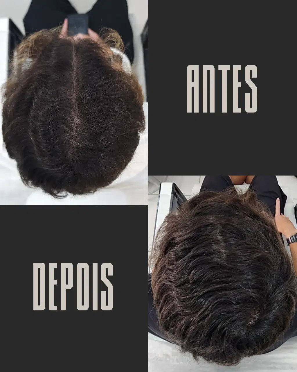 Calvície masculina