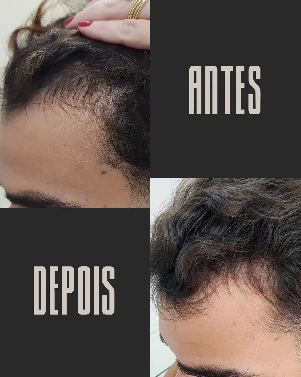 Calvície masculina