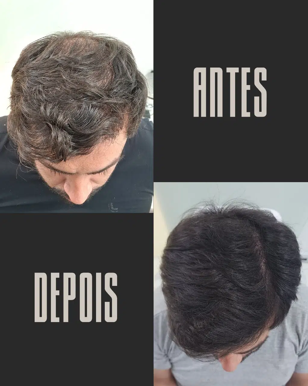 Calvície masculina