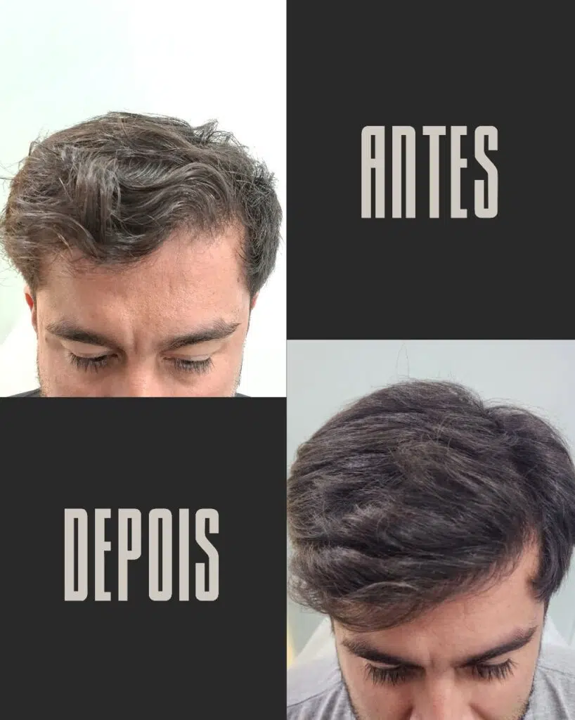 Calvície masculina